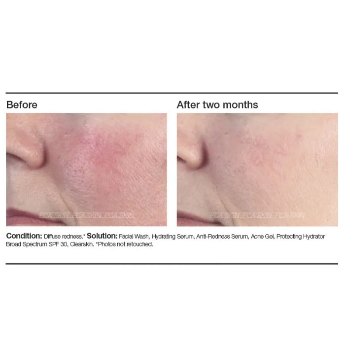 PCA Skin Anti-Redness Serum